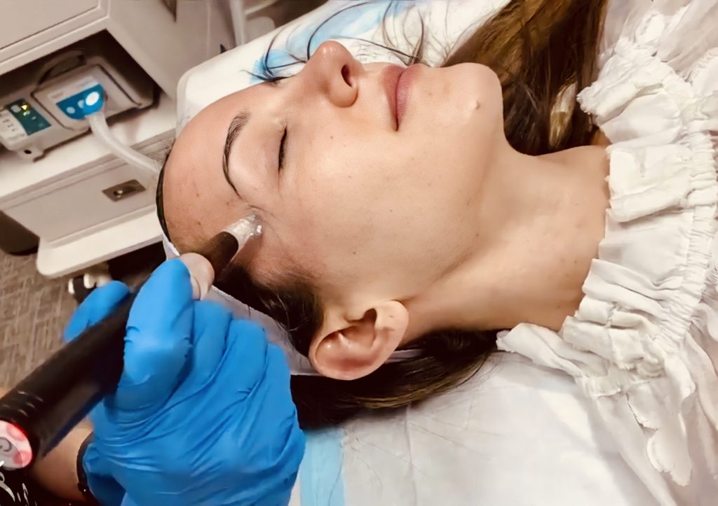 Que significa Microneedling- Que significa Microneedling- ¿Qué hace el microneedling? ¿Qué tan efectivo es el microneedling? ¿Cuánto dura el microneedling? ¿Cuánto cuesta el microneedling?